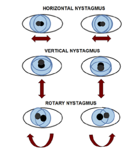 nystagmus