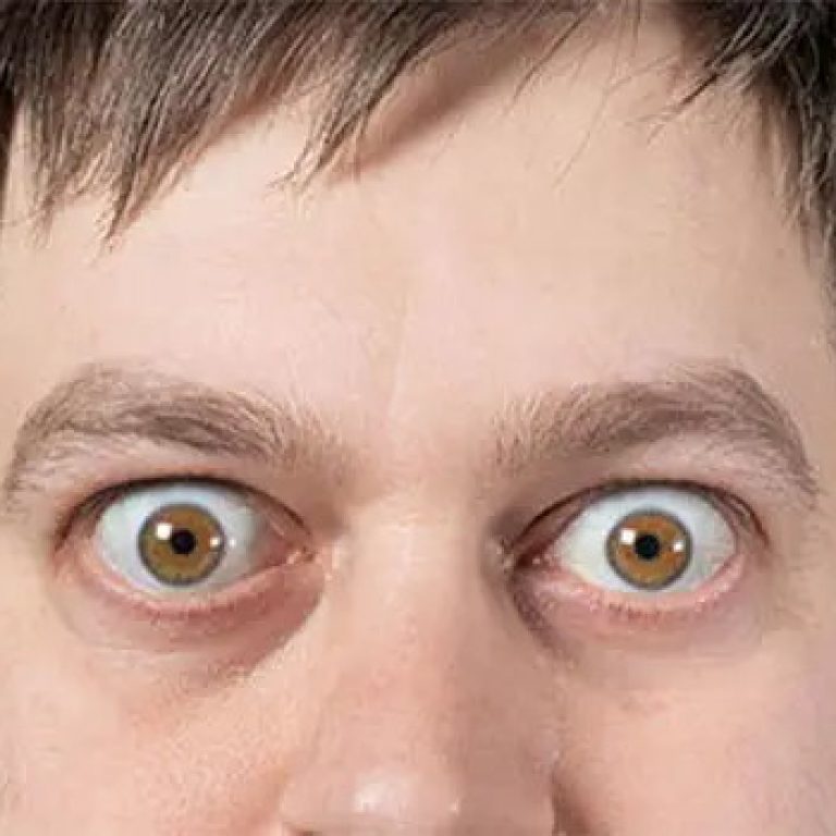 Bulging-Eyes