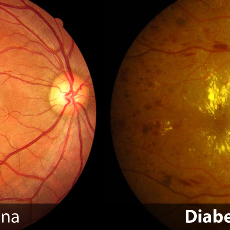 Diabetic-Retina